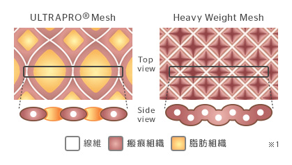 ULTRAPRO® Mesh Heavy Weight Mesh